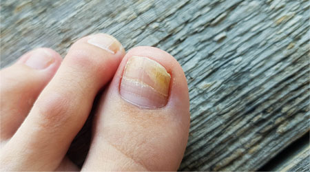 Toenail Fungus & Nail Restoration