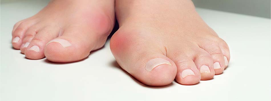 Bunions in Sarasota, FL