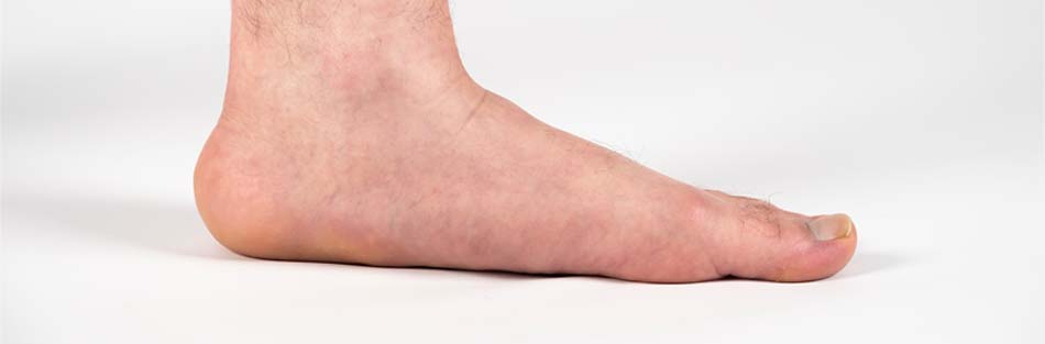 Flat Feet in Sarasota, FL