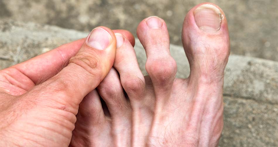 Hammertoes in Sarasota, FL