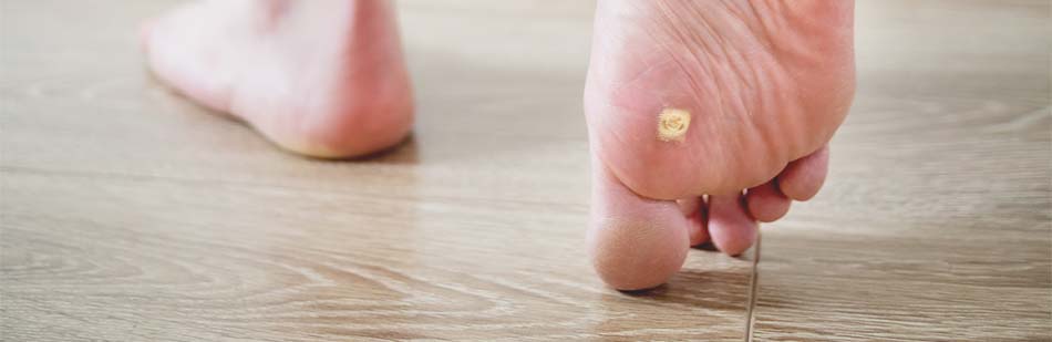 Foot Warts in Sarasota, FL